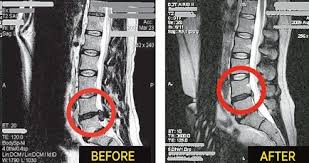 Before and After with Spinal Decompression